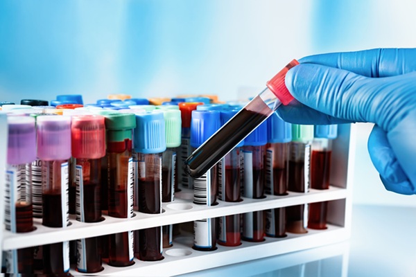 Image: The new analysis of blood samples links specific protein patterns to five- and ten-year mortality risk (Photo courtesy of Adobe Stock)