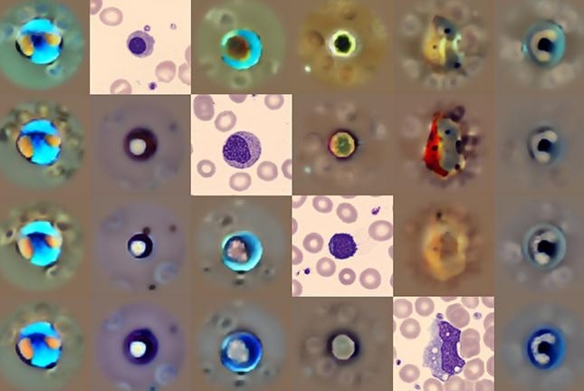 Image: The AI tool can analyze abnormalities in the shape and form of blood cells (Simon Deltadahl et al. Nature Machine Intelligence (2025). DOI: 10.1038/s42256-025-01122-7)