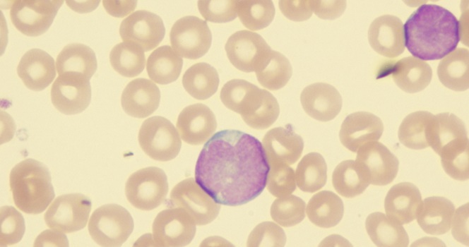 Image: The newly discovered cells explain why some children with acute lymphoblastic leukemia do not respond well to treatment (Photo courtesy of Shutterstock)