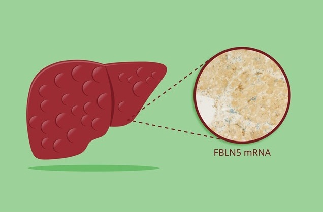 Image: FBLN5 detection in human hepatic stellate cells could act as an early warning sign of liver damage (Photo courtesy of Osaka Metropolitan University)