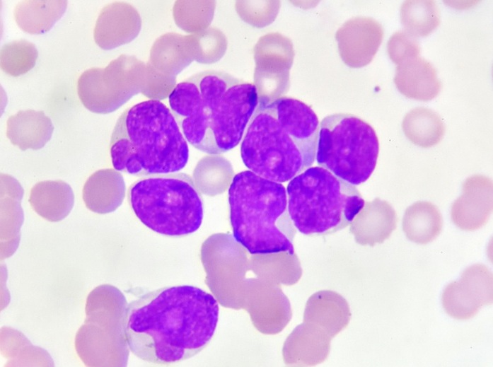 Image: Residual leukemia cells may predict long-term survival in acute myeloid leukemia (Photo courtesy of Shutterstock)
