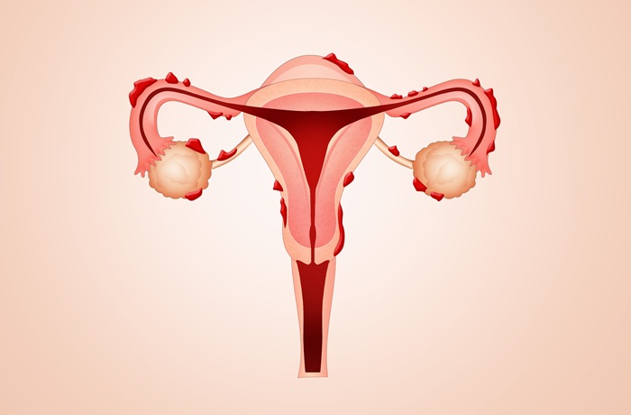 Image: The noninvasive blood-based test can confirm the presence of endometriosis among symptomatic women (Photo courtesy of Adobe Stock)