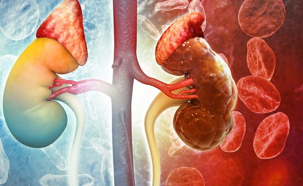 Image: Targeted prevention can cut severe kidney injury after major surgery (Photo courtesy of 123RF)