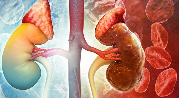 Image: Targeted prevention can cut severe kidney injury after major surgery (Photo courtesy of 123RF)