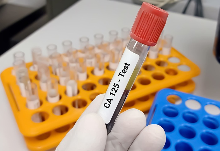 Image: The draft guideline proposes age-adjusted CA125 thresholds for ovarian cancer detection (Photo courtesy of Adobe Stock)