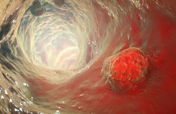 Image: The updated blood test has shown improved accuracy for early colorectal cancer detection (Photo courtesy of 123RF)