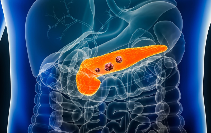 Image: Genetic analysis can reveal how complement system dysfunction may influence pancreatic cancer risk (Photo courtesy of Adobe Stock)