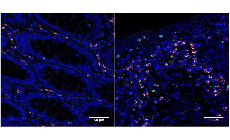 Image: Microscopy images of colon tissue samples from IBD patients under remission (left) and with active disease (right) (Photo courtesy of Emily Thompson)