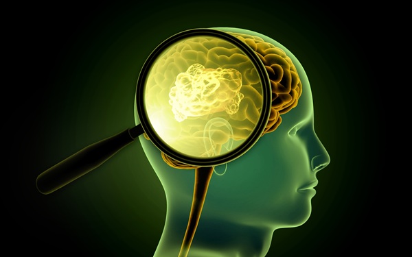 Image: Researchers have identified a previously unrecognized molecular subgroup of meningiomas (photo courtesy of Adobe Stock)