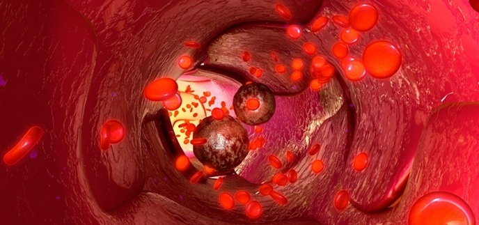 Image: Circulating tumor cells isolated from blood samples could help guide immunotherapy decisions (Photo courtesy of Shutterstock)