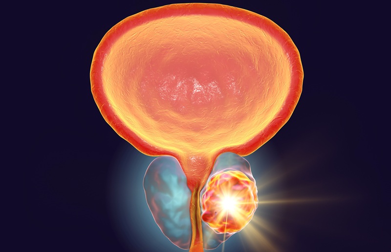 Image: The new model aims to identify prostate cancer patients likely to benefit from treatment (Photo courtesy of Adobe Stock)
