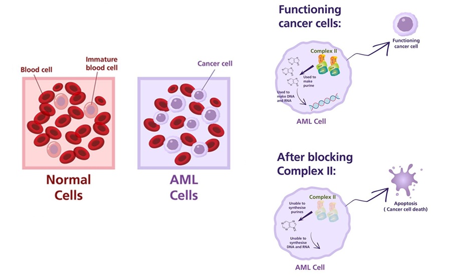 Image: Elevated Complex II levels were linked to treatment resistance and poorer survival in AML patients (Photo courtesy of Xu Lisheng/Duke-NUS Medical School)