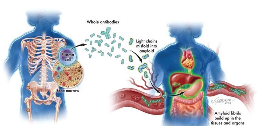 Image: AL amyloidosis is a rare, life-threatening bone marrow disorder (Wangsa, S P et al., Bioscientia Medicina; doi.org/10.37275/bsm.v7i11.889)