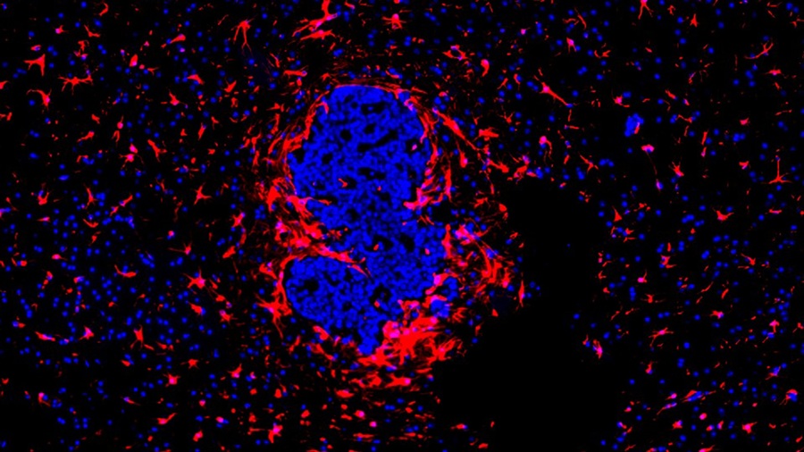Image: Immunofluorescence image of reactive astrocytes (red) in the area surrounding sEcad-high cancer cells (blue, center) (Photo courtesy of Debeb Laboratory)