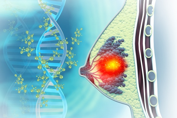 mage: Advanced polygenic risk score models use DNA variation to better predict breast cancer risk in African American women (Photo courtesy of Shutterstock)