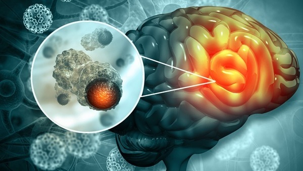 Image: Microscopic analysis of immune cells within meningioma tissue could improve prediction of tumor recurrence (Photo courtesy of 123RF)