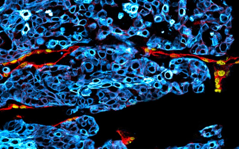 Image: Microscopic image of a human oral cancer tumour with lymphatic vessels (red and yellow) running between the cancer cells (blue) (Photo courtesy of University of Turku)