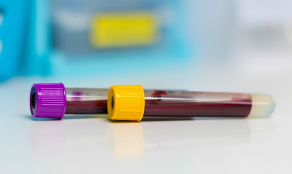 Image: Researchers have identified rare circulating bone precursor cells in blood that could signal heterotopic ossification (Photo courtesy of 123RF)