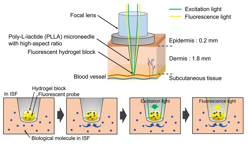 Image: The biodegradable microneedle device analyzes glucose in interstitial fluid without requiring traditional blood sampling (Fukuhara, M. et al., J Mater Chem B (2025). DOI: 10.1039/D5TB00385G)