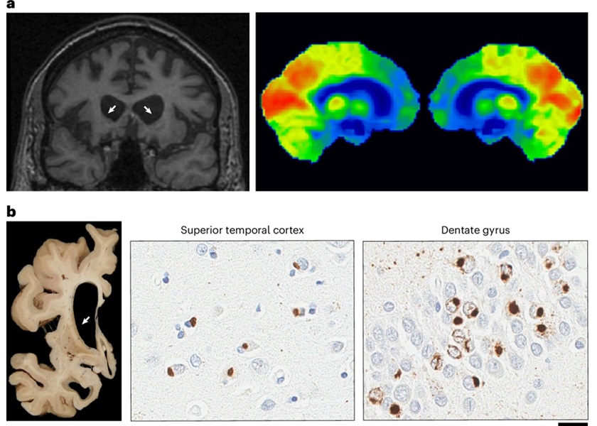 Image: Characteristic neuroradiologic and neuropathologic features of aFTLD-U (De Coster, W. et al., Nat Genet (2026). DOI: 10.1038/s41588-026-02537-7) Image: Characteristic neuroradiologic and neuropathologic features of aFTLD-U (De Coster, W. et al., Nat Genet (2026). DOI: 10.1038/s41588-026-02537-7)