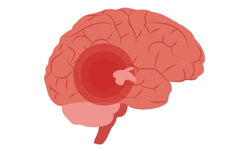 Image:The insight may improve genetic diagnosis of focal epilepsy, including cases with normal MRI (photo courtesy of Adobe Stock) Image:The insight may improve genetic diagnosis of focal epilepsy, including cases with normal MRI (photo courtesy of Adobe Stock)