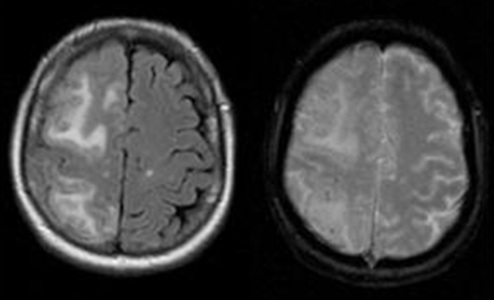 image: ARIA can appear as brain swelling or small hemorrhages on MRI scans and remains difficult to predict before treatment begins (Reisa A, Sperling et al, via Wikimedia Commons, CC BY 4.0)