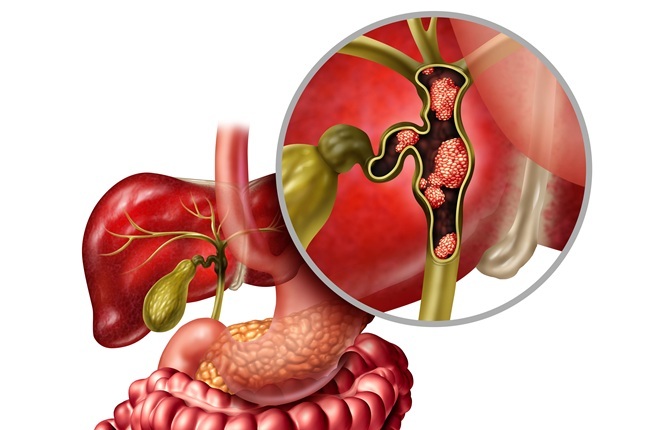 Image: The BiliSeq assay detects cancer-associated genetic mutations in bile duct tissue (photo courtesy of Adobe Stock)