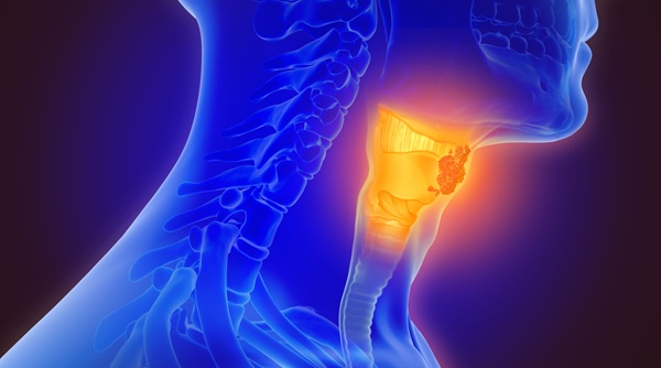 image: HPV DNA (ctDNA) measured in blood could help tailor treatment for HPV-related throat cancer (photo credit: Adobe Stock)