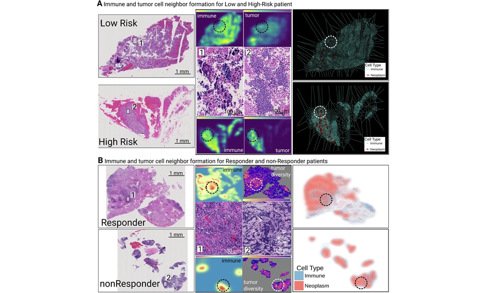 Image: Spatial characterization of immune–tumor interactions and treatment response across SCLC and extended phenotype models (Cristian Barrera et al, npj Precision Oncology (2026). DOI: 10.1038/s41698-025-01225-9)