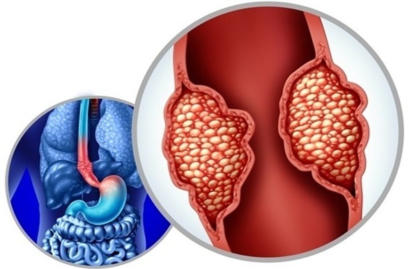 Image: New findings provide strong evidence that Barrett’s esophagus initiates esophageal adenocarcinoma and identify markers for earlier detection (photo courtesy of Shutterstock)