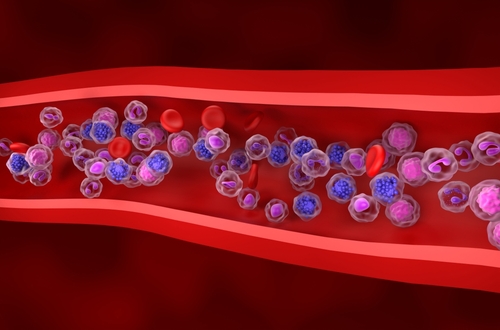 Image: Diffuse large B-cell lymphoma (DLBCL) is the most common form of non-Hodgkin lymphoma and often presents with aggressive clinical behavior (photo courtesy of Shutterstock)