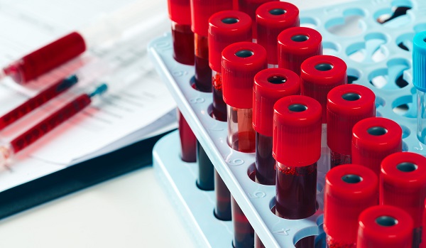 Image: An elevated neutrophil-to-lymphocyte ratio (NLR), a rato easily obtained from a routine blood count, was associated with both short- and long-term Alzheimer’s risk (photo credit: 123RF)