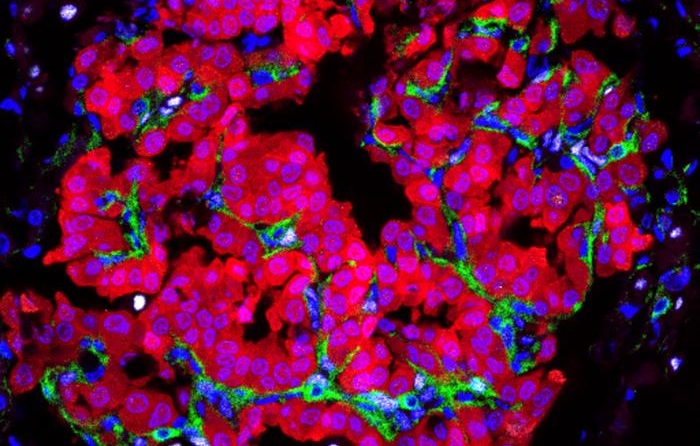  Image: Tumor cells (red) actively engage neighboring cells (green) to create a local environment that supports tumor growth, a new study from the lab of Dr. Joo-Hyeon Lee shows. The findings could eventually help doctors to better detect and treat cancer in its early stages (photo courtesy of Memorial Sloan Kettering Cancer Center)