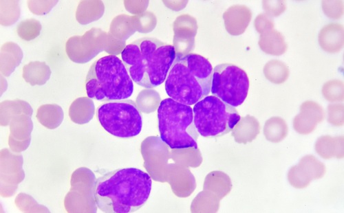 Image: New research shows genomic data can identify which precancerous cells progress to myeloid leukemia in children with Down syndrome (photo courtesy of Shutterstock)