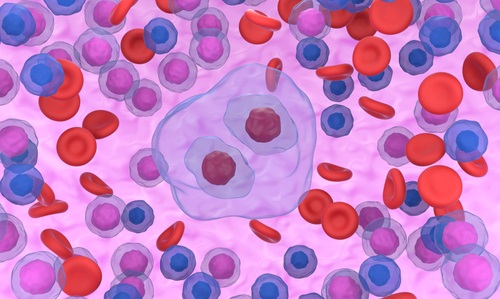 Image: Reed-Sternberg cells are a hallmark of Hodgkin lymphoma and are found in affected lymph nodes (photo courtesy of Shutterstock)