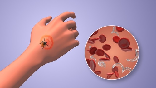 Image: New findings underscore limitations of current two-tiered diagnostics in early Lyme Disease infection and point to a need for improved medical education on test interpretation (photo courtesy of Shutterstock)
