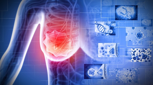 Image: The AidaBREAST assay integrates multimodal data to provide patient-specific 10-year recurrence risk and individualized predictions of radiation therapy benefit (photo courtesy of PreludeDx)