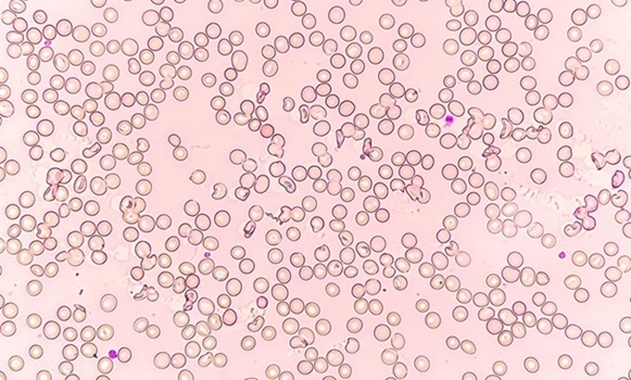 Image: Aplastic anemia is a rare, life-threatening condition where immune attack on blood stem cells impairs blood cell production (Photo courtesy of Shutterstock)