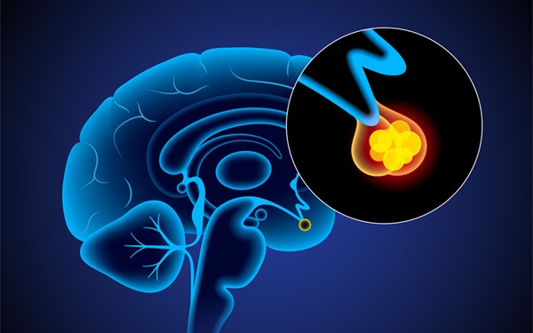 Image: The findings support tumor genomic testing in pituitary carcinomas and aggressive pituitary adenomas, to guide consideration of immunotherapy as a potential first-line option (photo courtesy of Adobe Stock)