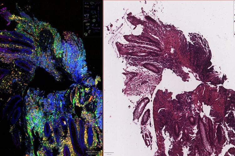 Image: Tissue sample spatial analysis (on left) and standard H&E image (on right) (Photo courtesy of QIMR Berghofer Medical Research Institute)