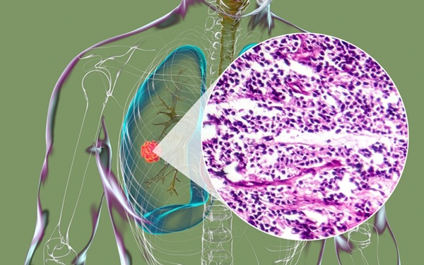 Image: Small cell lung cancer is an aggressive malignancy that often responds to initial chemotherapy but commonly relapses, creating an urgent need for reliable resistance biomarkers (image credit: Shutterstock)