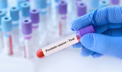 Image: IsoPSA is a blood-based test designed to aid in prostate biopsy decision‑making for men aged 50 years and older with elevated PSA levels (image credit: Shutterstock)