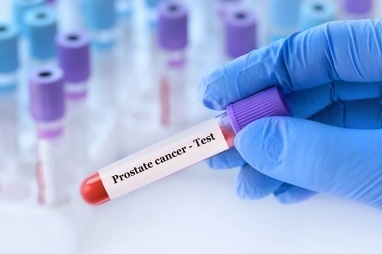 Image: IsoPSA is a blood-based test designed to aid in prostate biopsy decision‑making for men aged 50 years and older with elevated PSA levels (image credit: Shutterstock)