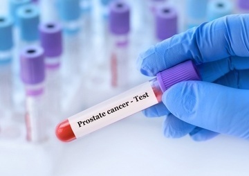 Image: IsoPSA is a blood-based test designed to aid in prostate biopsy decision‑making for men aged 50 years and older with elevated PSA levels (image credit: Shutterstock)