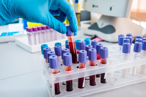 Image: Combining genetic factors with modifiable markers of biological ageing could enable a simple blood test to help identify dementia risk before symptoms emerge (photo courtesy of Shutterstock)