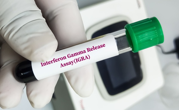 Image: The findings suggest IGRA control responses offer a scalable measure of immune function from a widely used clinical assay (image credit: Adobe Stock)