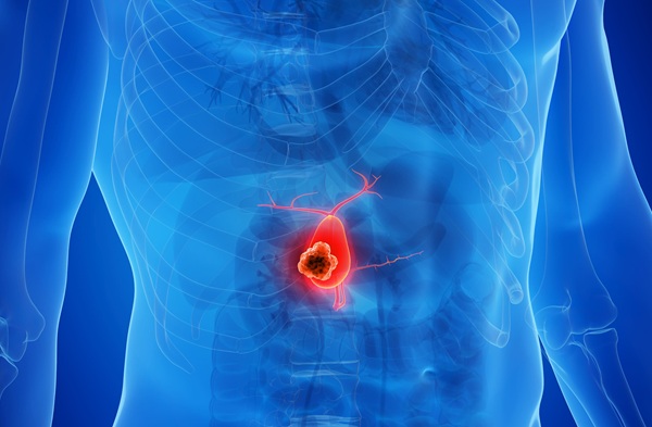 Image: Findings show that genetic changes inside cancer cells may help explain why some patients with gallbladder cancer have poorer outcomes despite similar treatment (image credit: 123RF)