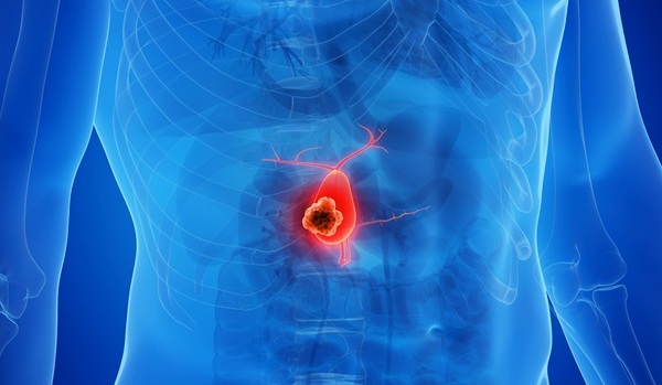 Image: Findings show that genetic changes inside cancer cells may help explain why some patients with gallbladder cancer have poorer outcomes despite similar treatment (image credit: 123RF)