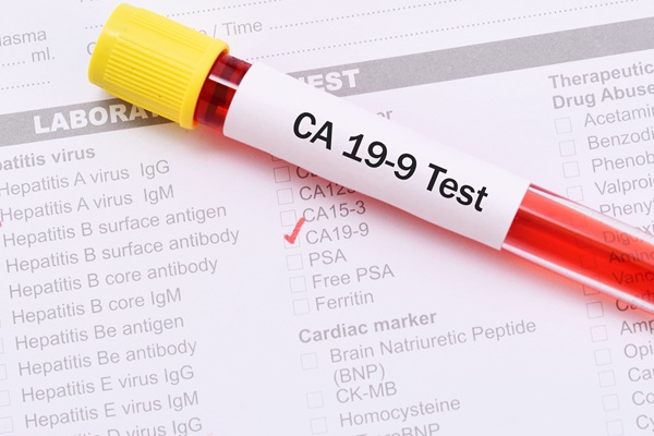 Image: New findings suggest that standard “normal” CA19-9 cutoffs may mask aggressive disease in nonproducers, while a dual-threshold model could reduce misinterpretation (image credit: Adobe Stock)