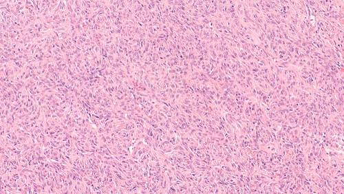 Image: Physicians currently use the Demicco score, which considers patient age, tumor size, and microscopic appearance, to estimate SFT aggressiveness, but uncertainty can remain about which patients need closer surveillance (image credit: Shutterstock)